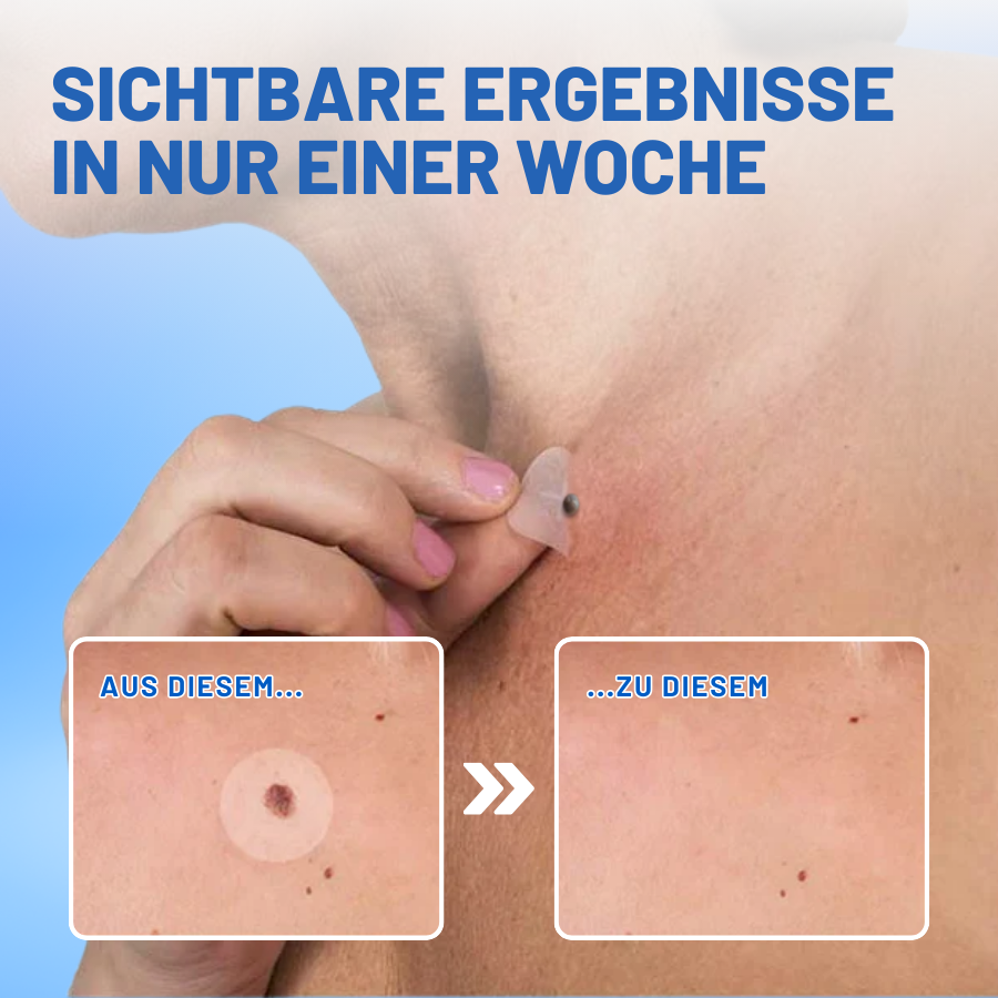 Fivfivgo® Profi Muttermale & Warzen entfernen Haut Tag Patch