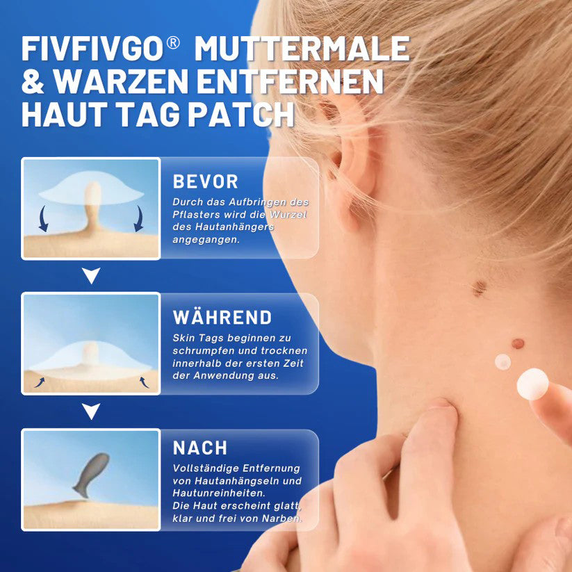 Fivfivgo® Profi Muttermale & Warzen entfernen Haut Tag Patch