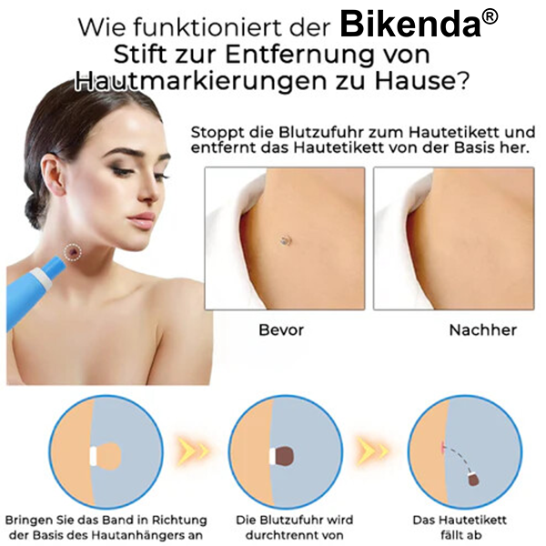 Bikenda® Stift zur Entfernung von Hautmarkierungen zu Hause